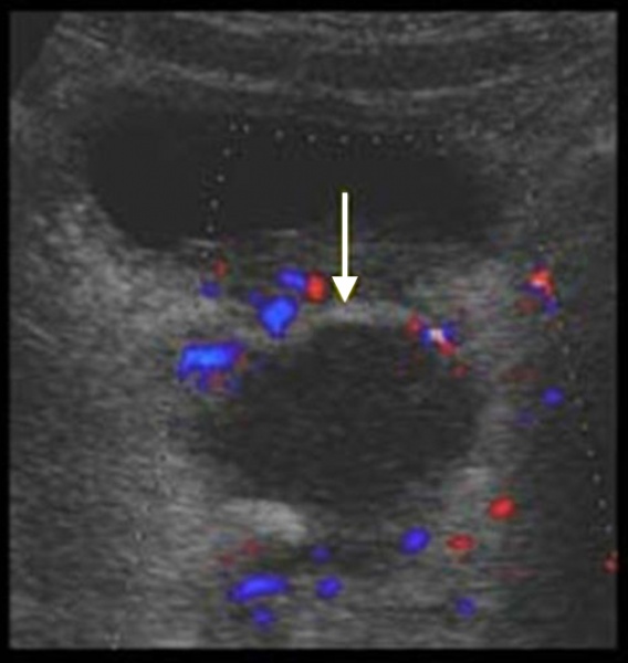 УЗИ органов малого таза. Абсцесс дугласова пространства после аппендэктомии