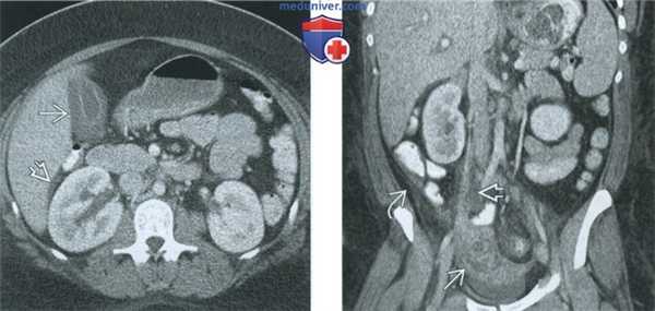 КТ, МРТ, УЗИ при тубоовариальном абсцессе