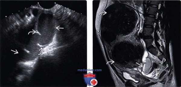 Методы обследования тубоовариального абсцесса