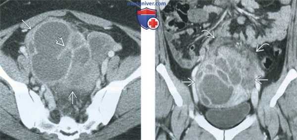 КТ, МРТ, УЗИ при тубоовариальном абсцессе