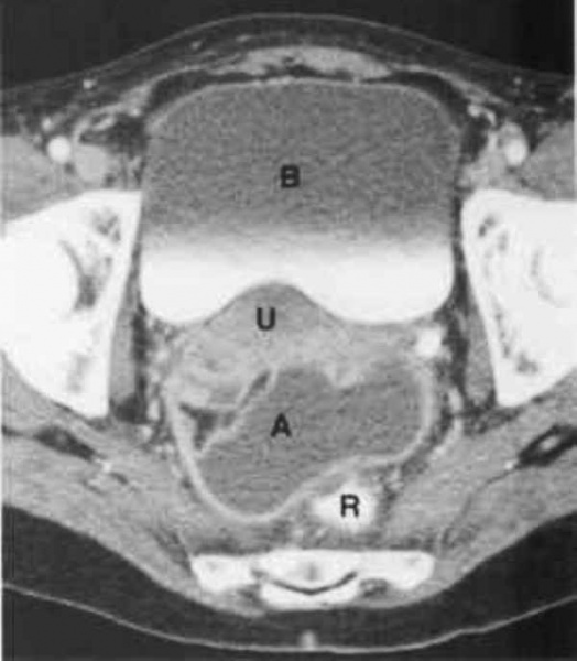 КТ органов малого таза. На снимке: абсцесс, отграниченный стенкой (А), прямая кишка (R), матка (U), мочевой пузырь (B)