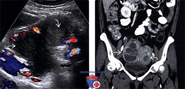 Методы обследования тубоовариального абсцесса