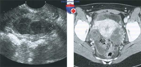 КТ, МРТ, УЗИ при тубоовариальном абсцессе