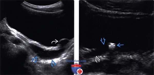Методы обследования уретероцеле