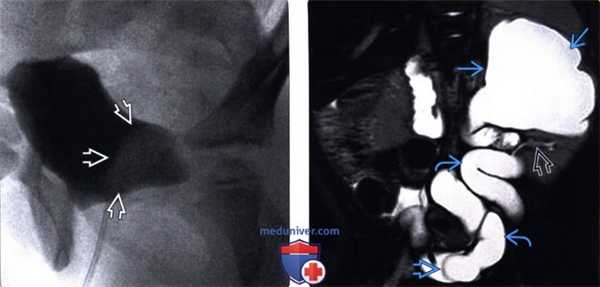 Методы обследования уретероцеле