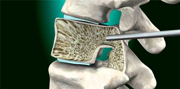 Введение в позвонок иглы Ямшиди