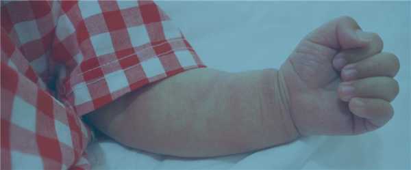 атопический дерматит