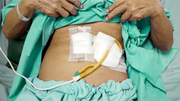 Питание через гастростому