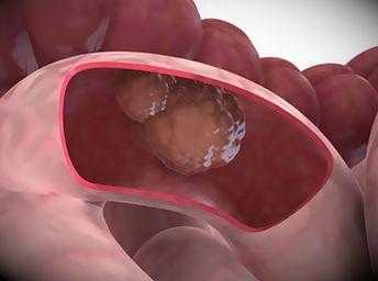 Рак кишечника симптомы и проявления