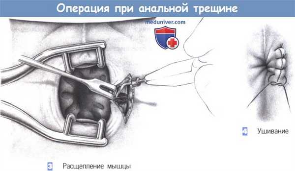 Этапы и техника операции при анальной трещине