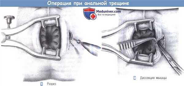 Этапы и техника операции при анальной трещине
