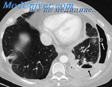 бронхоспирометрия