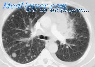 бронхография