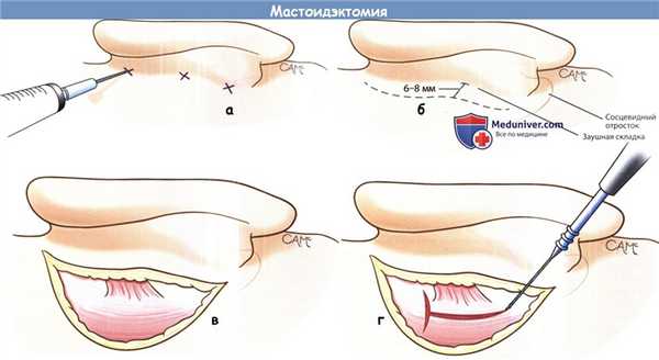 Мастоидэктомия