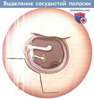 Выделение сосудистой полоски перед разрезом
