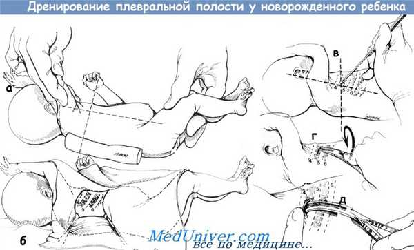 Дренирование плевральной полости у новорожденного ребенка