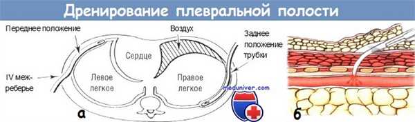 Дренирование плевральной полости у новорожденного ребенка