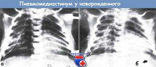 Пневмомедиастинум у новорожденного ребенка