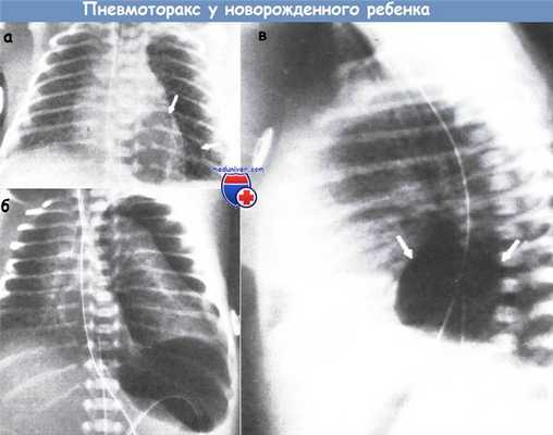 Пневмоторакс у новорожденного ребенка