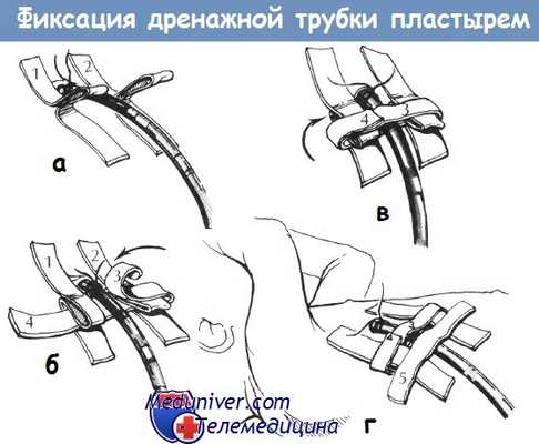 Фиксация дренажной трубки плевральной полости