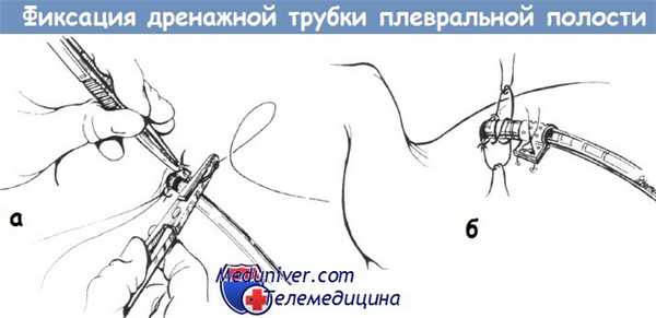 Фиксация дренажной трубки плевральной полости