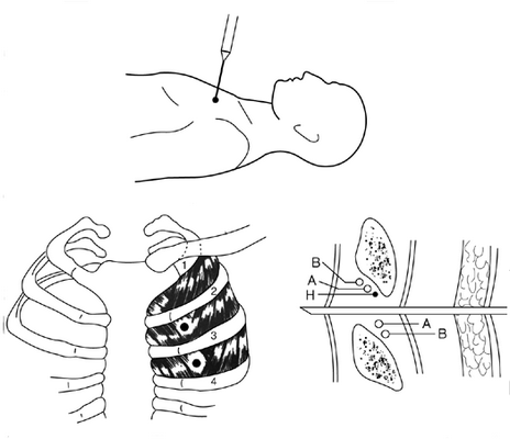 алгоритм проведения плевральной пункции