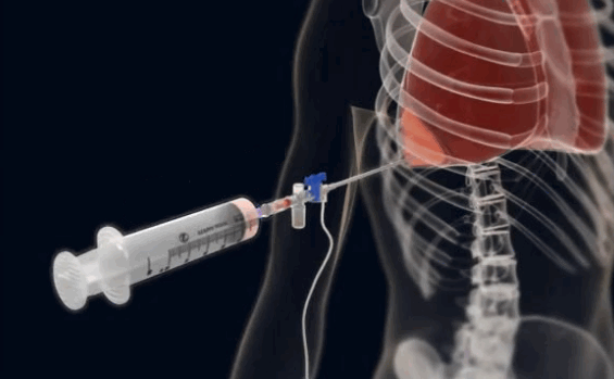 плевральная пункция