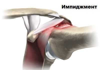 Импиджмент