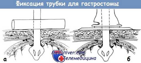Фиксация трубки для гастростомы