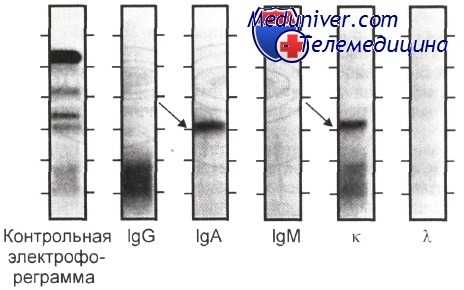 иммунофиксация парапротеинов