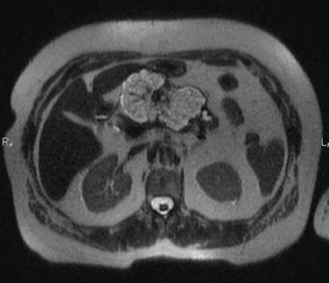 МРТ брюшной полости в аксиальной плоскости