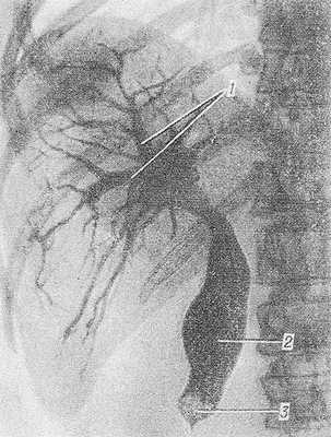 Рис. 1. Чрескожная чреспеченочная холангиография при желчнокаменной болезни (прямая проекция): желчные протоки (1) и общий желчный проток (2) расширены, в дистальной части общего желчного протока имеется окклюзирующий камень (3).
