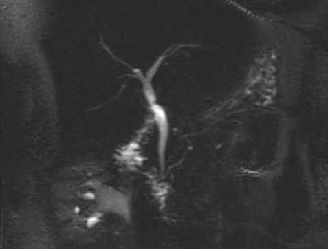 МРТ холангиография