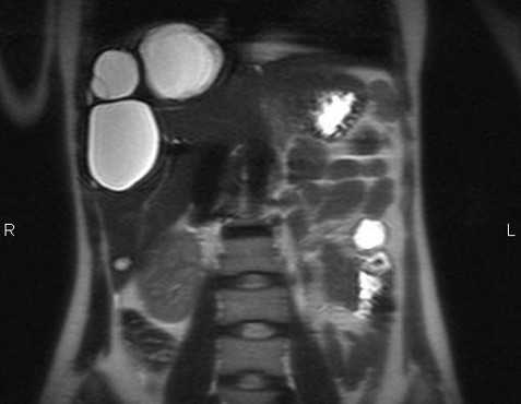 МРТ брюшной полости в корональной плоскости. Очаговые кистозные образования печени паразитарной природы