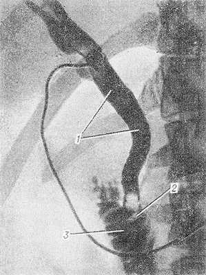 Рис. 2. Интраоперационная холангиография при желчнокаменной болезни (прямая проекция): общий желчный проток (1) расширен, в его дистальной части группа камней (2), контрастное вещество выходит в двенадцатиперстную кишку (3); в общем желчном протоке виден катетер.