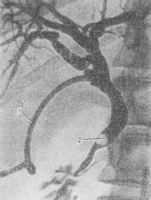 Рис. 3. Послеоперационная чреззондовая холангиография при желчнокаменной болезни (прямая проекция): через зонд (1) заполнены контрастным веществом внутрипеченочные и внепеченочные желчные протоки, в дистальном отделе общего желчного протока виден дефект наполнения, вызванный камнем (2).