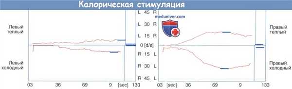Калорическая стимуляция