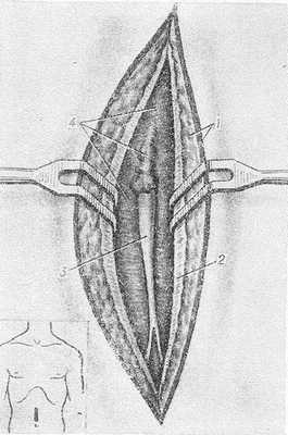 Рис. 1. Схематическое изображение положения пупочной вены в предбрюшинной клетчатке: 1 — кожа и подкожная клетчатка; 2 — апоневроз; 3 —пупочная вена; 4 — предбрюшинная клетчатка. Слева внизу показано место разреза.