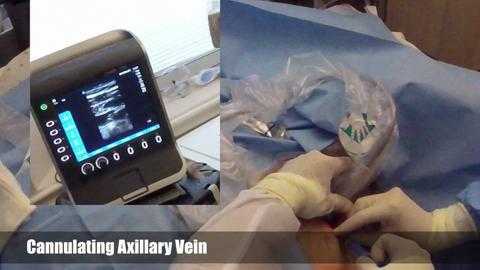 Катетеризация подключичной вены под ультразвуковым контролем