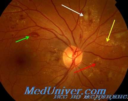 диабетическая ретинопатия