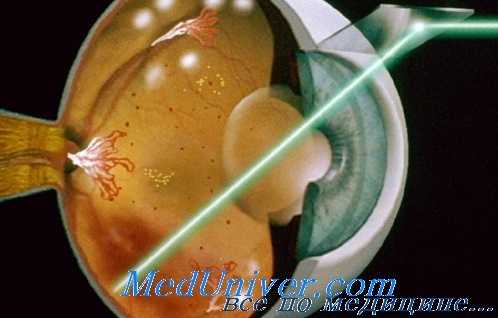 лазерная фотокоагуляция сетчатки