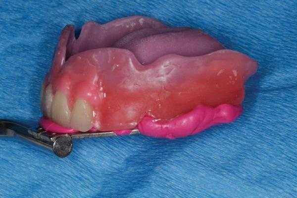 Системный подход в изготовлении полных съемных протезов