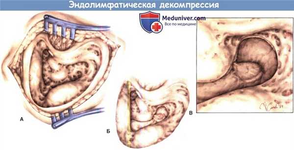 Эндолимфатическая декомпрессия при болезни Меньера