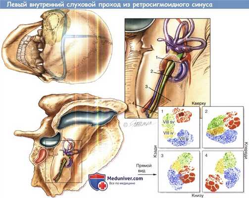 Содержимое левого внутреннего слухового прохода из ректосигмоидного синуса