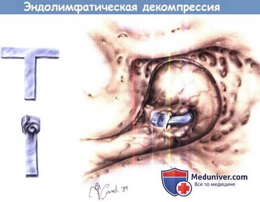 Эндолимфатическая декомпрессия при болезни Меньера
