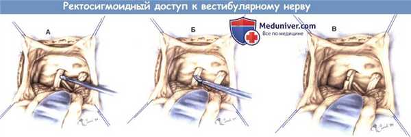 Ректосигмоидный доступ к вестибулярному нерву