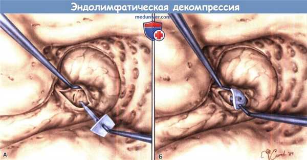 Эндолимфатическая декомпрессия при болезни Меньера