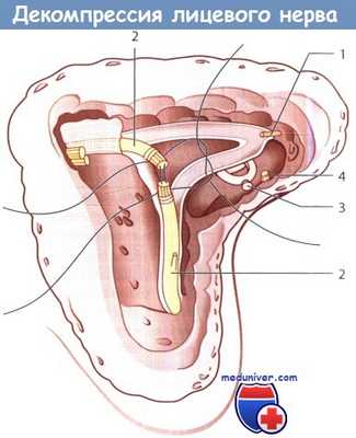 Принципы декомпрессии лицевого нерва