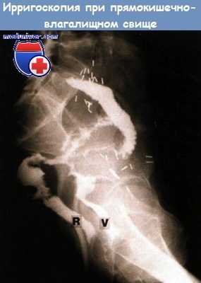 Видео анатомии диафрагмы таза, промежности, мочеполовой диафрагмы