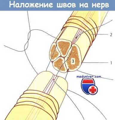 Наложение швов на нерв